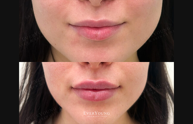 Lip Fillers in Vancouver - Before & After 2 | EverYoung Skin Clinic