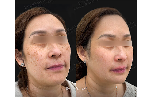 PicoSure Skin Revitalization - Before & After 1 | EverYoung Skin Clinic