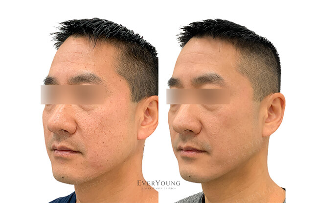 PicoSure Skin Revitalization - Before & After 2 | EverYoung Skin Clinic