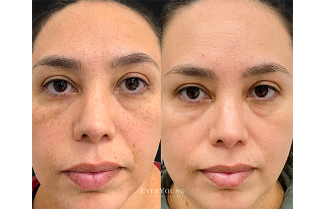 PicoSure Skin Revitalization - Before & After 3 | EverYoung Skin Clinic