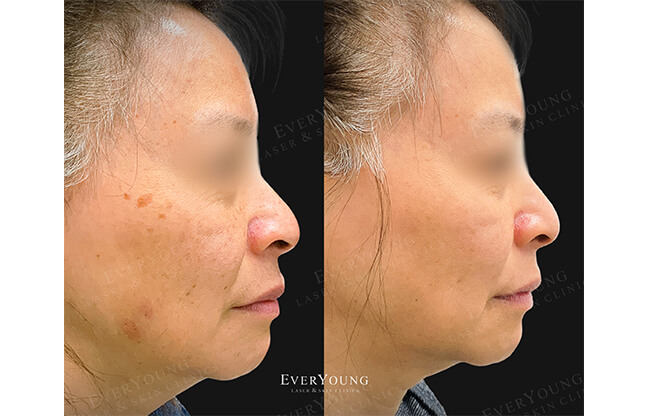 PicoSure Skin Revitalization - Before & After 4 | EverYoung Skin Clinic