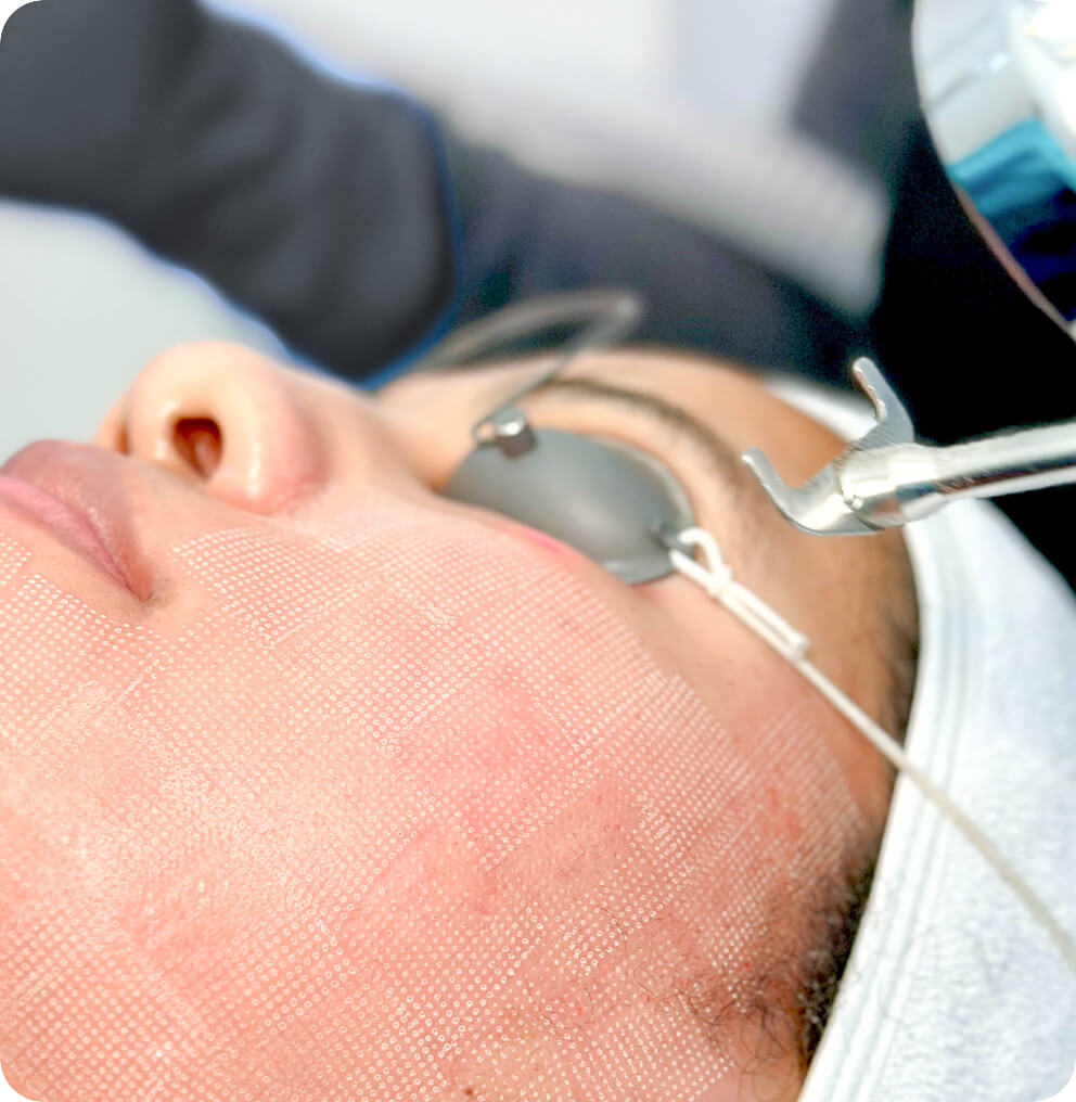 ProFractional Laser Vancouver | EverYoung Skin Clinic