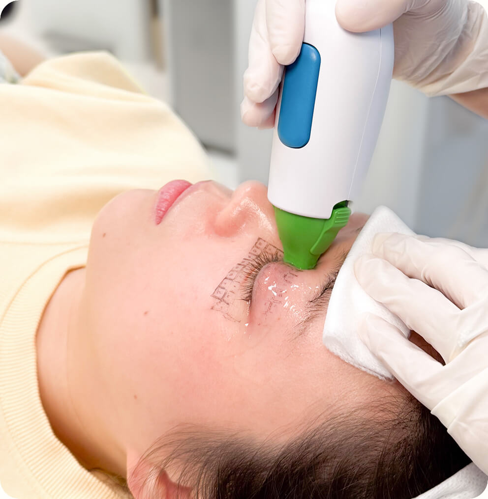 Thermage® FLX Vancouver | EverYoung Skin Clinic