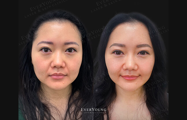 TMJ Botox Treatment - Before & After 1 | EverYoung Skin Clinic
