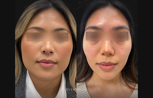 TMJ Botox Treatment - Before & After 2 | EverYoung Skin Clinic
