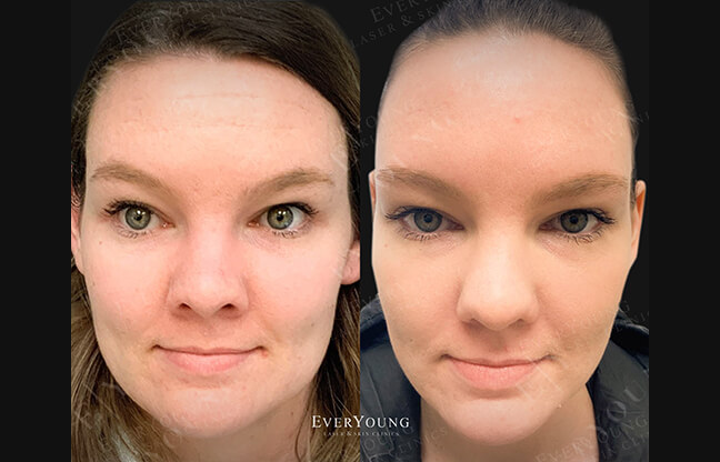 TMJ Botox Treatment - Before & After 3 | EverYoung Skin Clinic