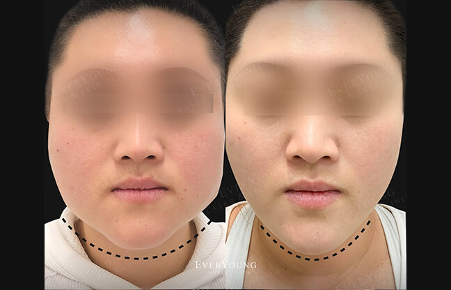 TMJ Botox Treatment - Before & After 4 | EverYoung Skin Clinic