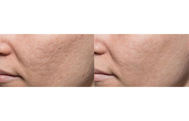 Bellafill® Acne Scar - Before & After 1 | EverYoung Skin Clinic