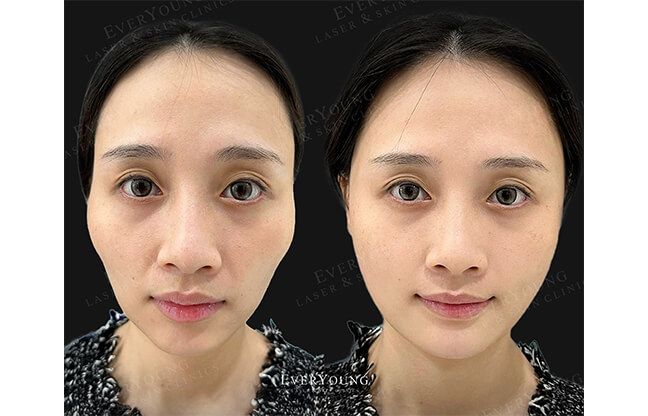 Dermal Filler - Before & After 1 | EverYoung Skin Clinic Vancouver