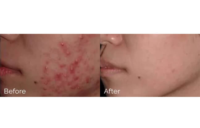 Emergency Cyst Removal - Before & After 2 | EverYoung Skin Clinic