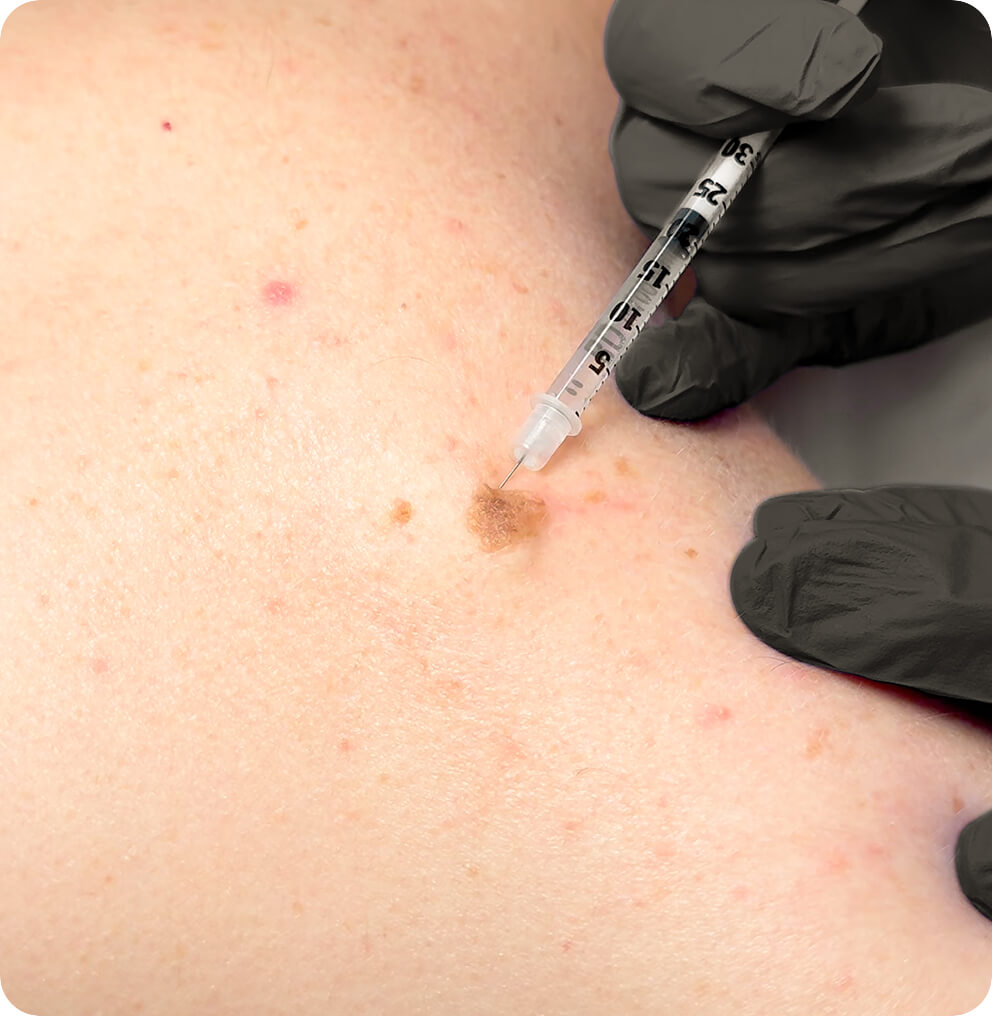 Laser Mole Removal Vancouver | EverYoung Skin Clinic