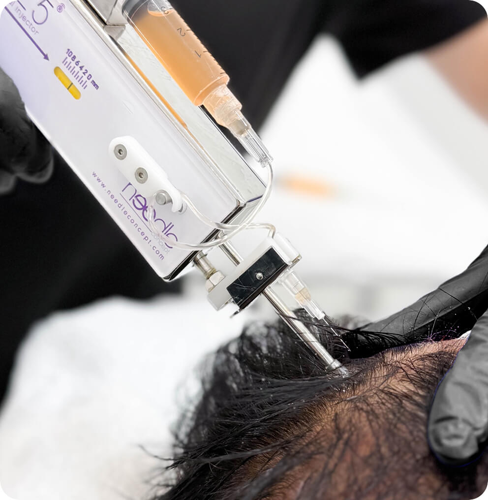 PRP Hair Loss Treatment | EverYoung Skin Clinic Vancouver