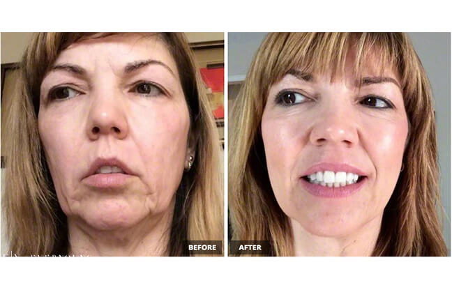 PRP Vampire Facial Rejuvenation - Before & After | EverYoung Skin Clinic