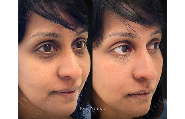 Under Eye Fillers - Before & After 3 | EverYoung Skin Clinic Vancouver