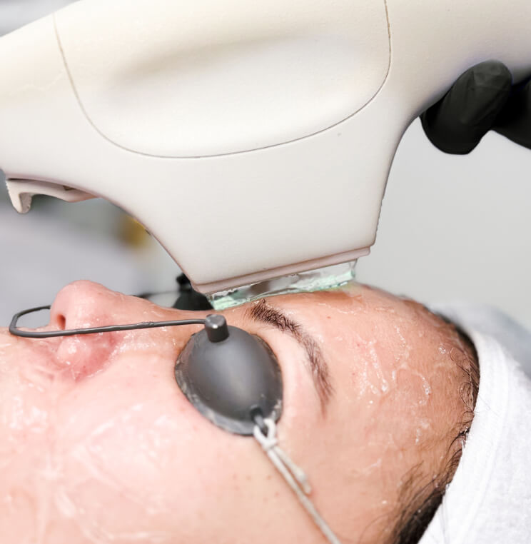 BBL Photofacial Vancouver | EverYoung Skin Clinic