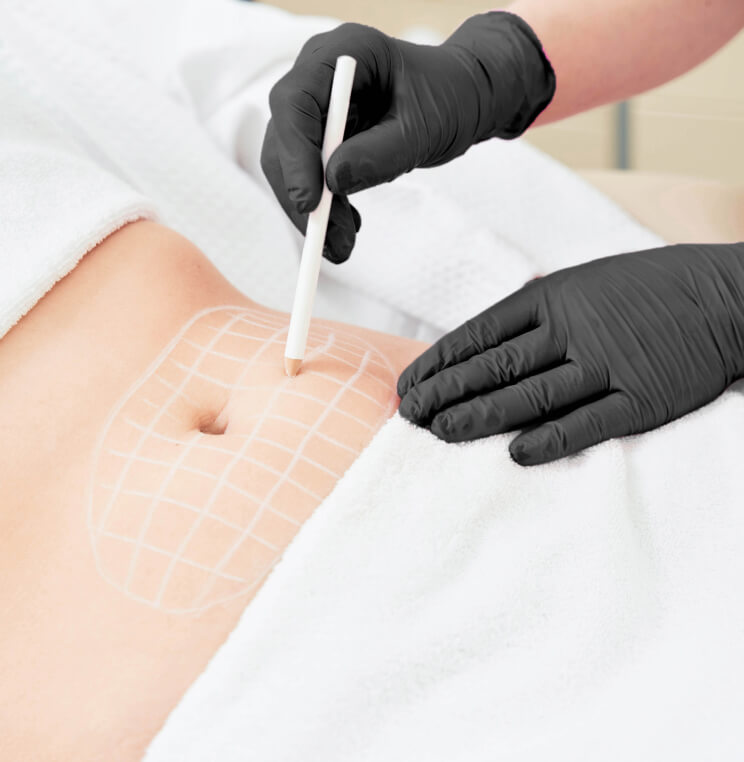 Lipodissolve Vancouver | EverYoung Skin Clinic