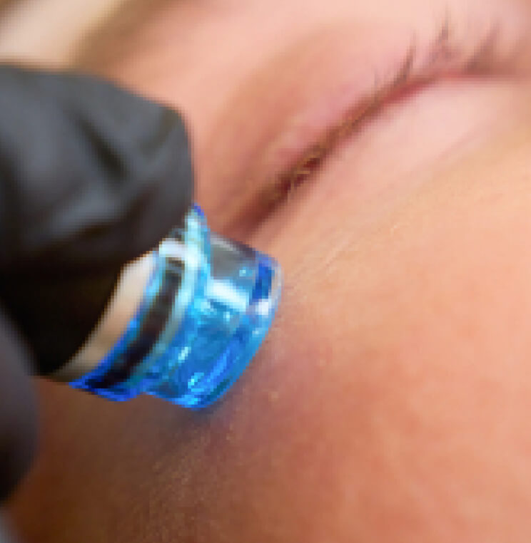 HydraFacial MD® Treatment Vancouver | EverYoung Skin Clinic