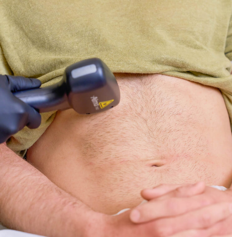 Laser Hair Removal Vancouver | EverYoung Skin Clinic