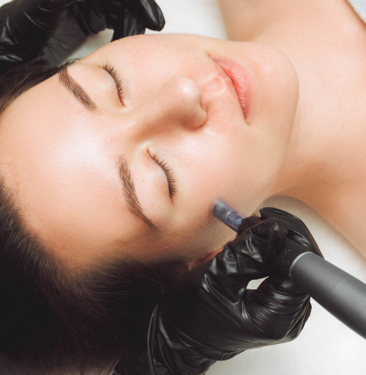 Microneedling Vancouver | EverYoung Skin Clinic