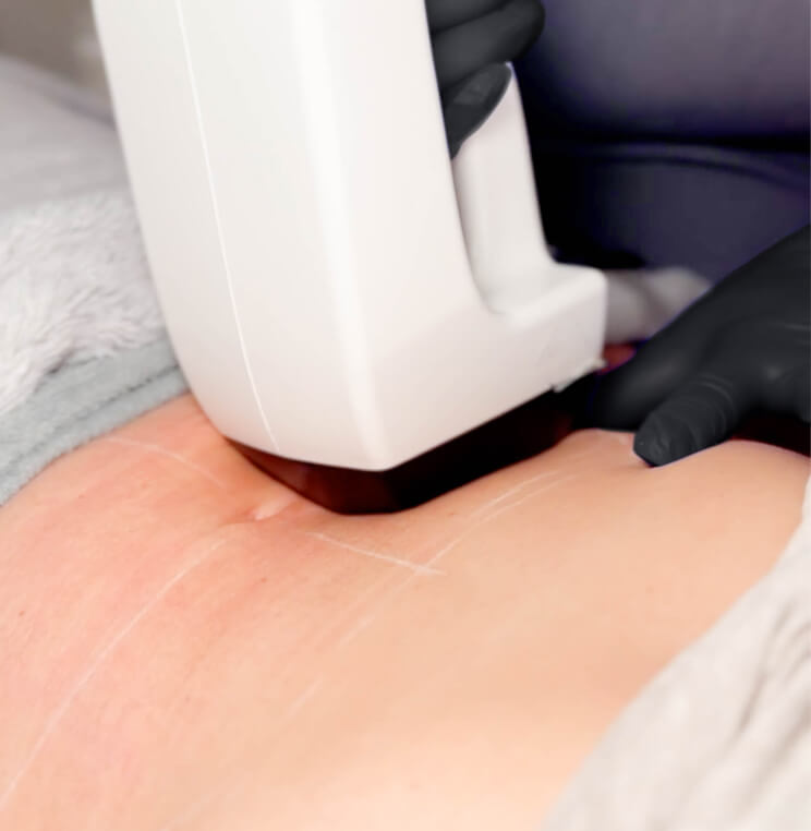 InMode MiniFX Treatment Vancouver | EverYoung Skin Clinic