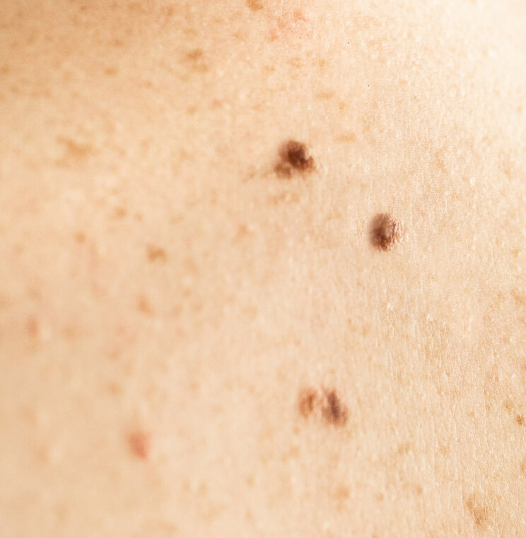 Mole Removal Vancouver | EverYoung Skin Clinic