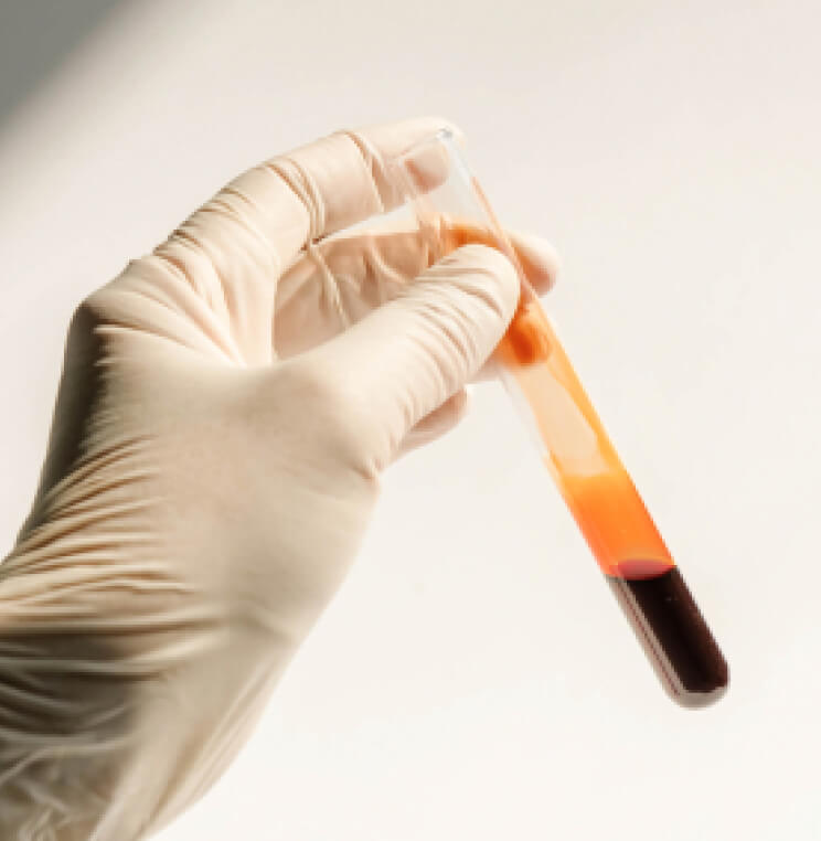 PRP Vampire Facial Vancouver | EverYoung Skin Clinic