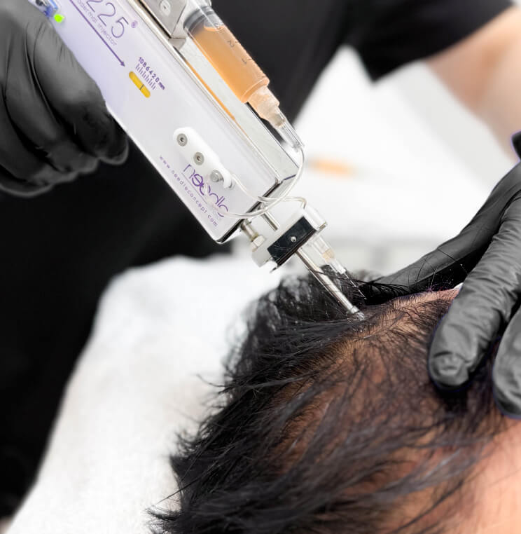 PRP for Hair Loss Vancouver | EverYoung Skin Clinic