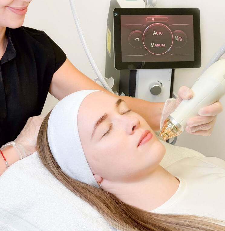 Secret™ RF Microneedling Vancouver | EverYoung Skin Clinic