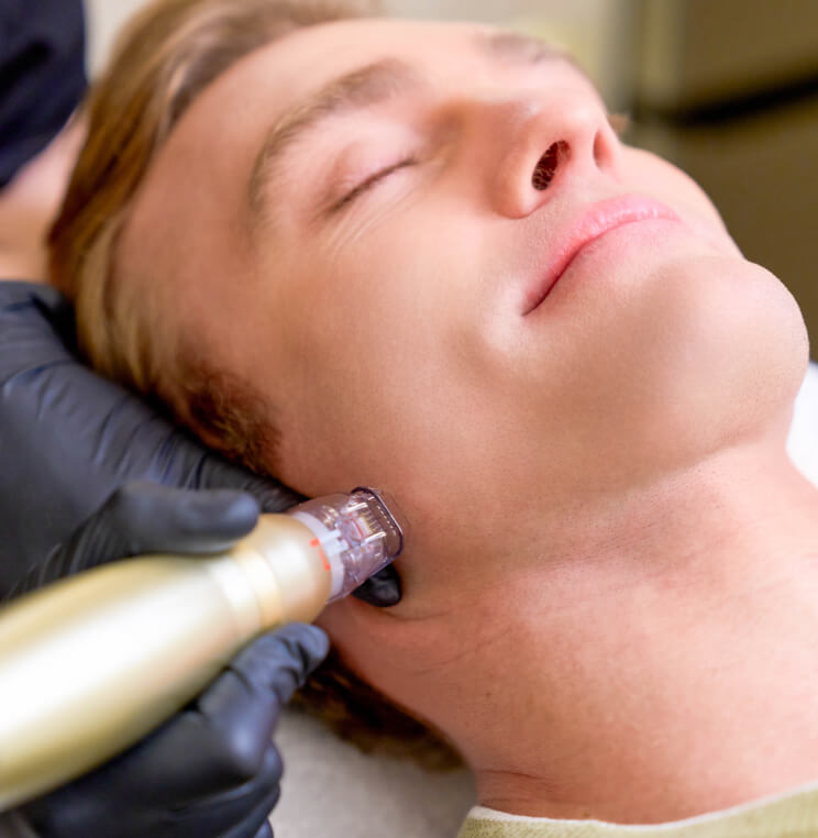 Sylfirm X Treatment Vancouver | EverYoung Skin Clinic