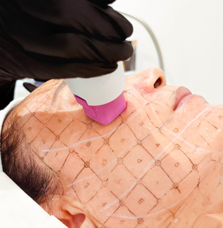 Thermage® FLX Vancouver | EverYoung Skin Clinic