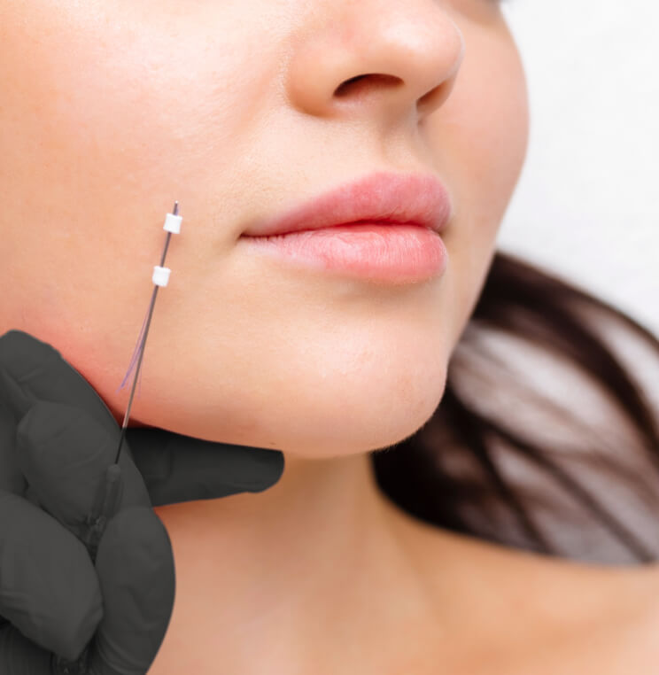 Thread Lift & Silhouette InstaLift Vancouver | EverYoung Skin Clinic