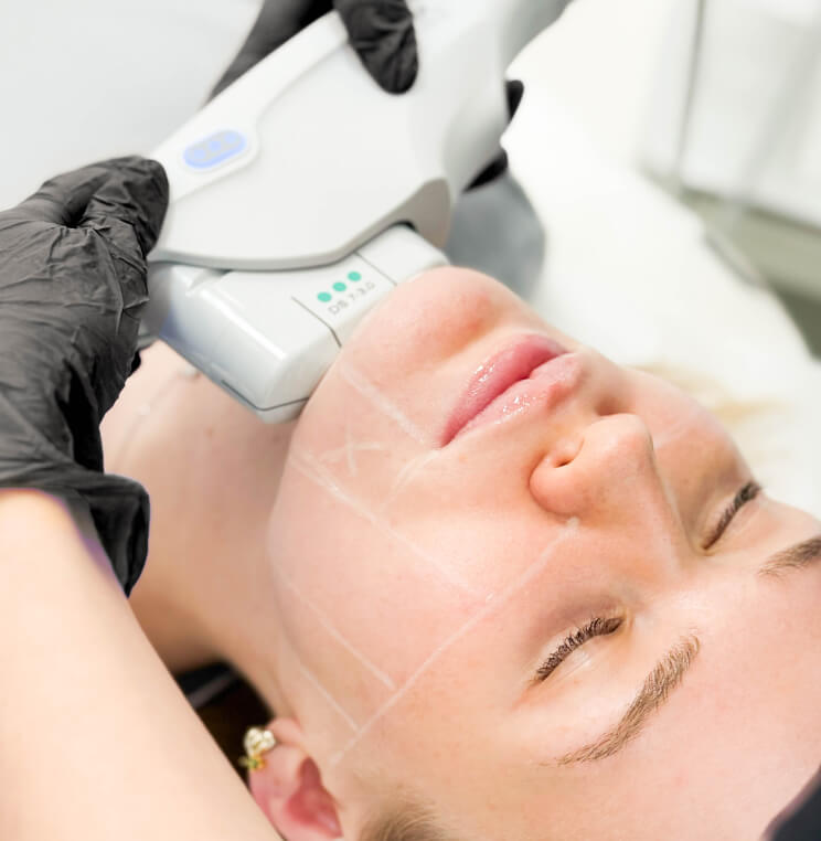 Ultherapy Skin Tightening Vancouver | EverYoung Skin Clinic
