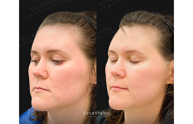 Excel V™ Laser - Before & After 1 | EverYoung Skin Clinic Vancouver