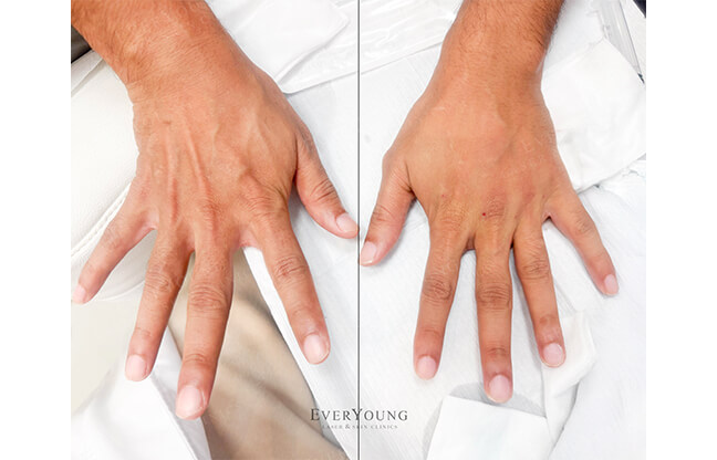 Radiesse® Hand Rejuvenation - Before & After | EverYoung Skin Clinic