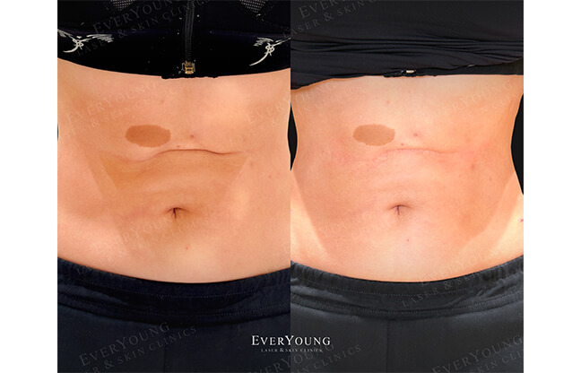 Radiesse® Before & After Treatment | EverYoung Skin Clinic