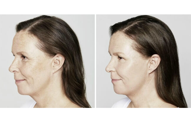 Restylane Skin Boosters Treatment - Before & After 1 | EverYoung Skin Clinic Vancouver
