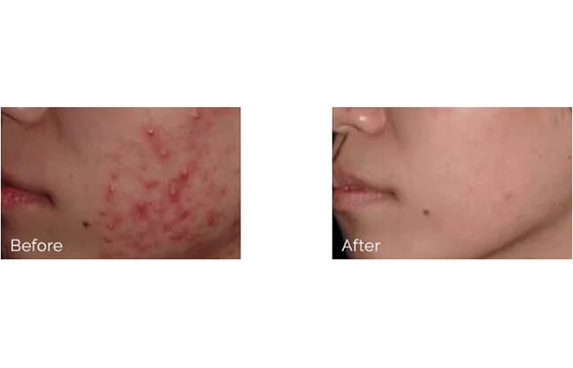 Acne Treatments - Before & After 2 | EverYoung Skin Clinic
