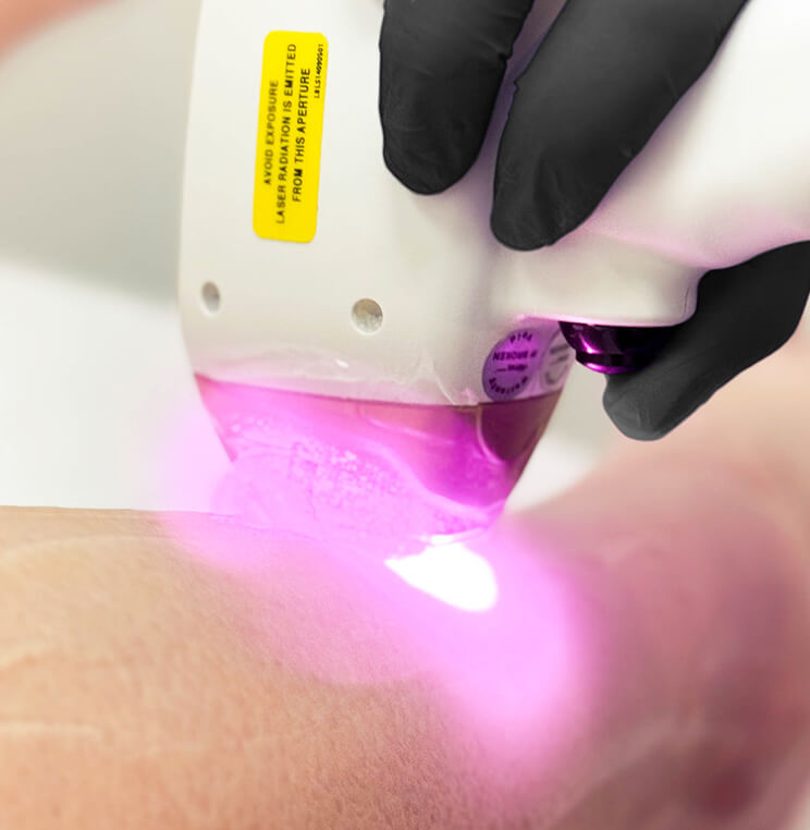Harmony® XL Pro Dye VL Laser | EverYoung Skin Clinic