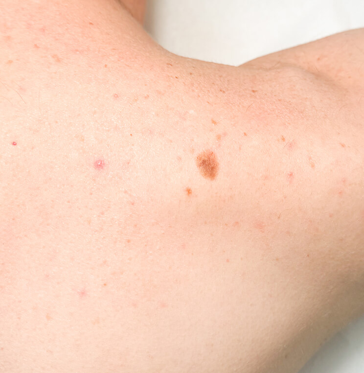 Conditions: Moles | EverYoung Skin Clinic