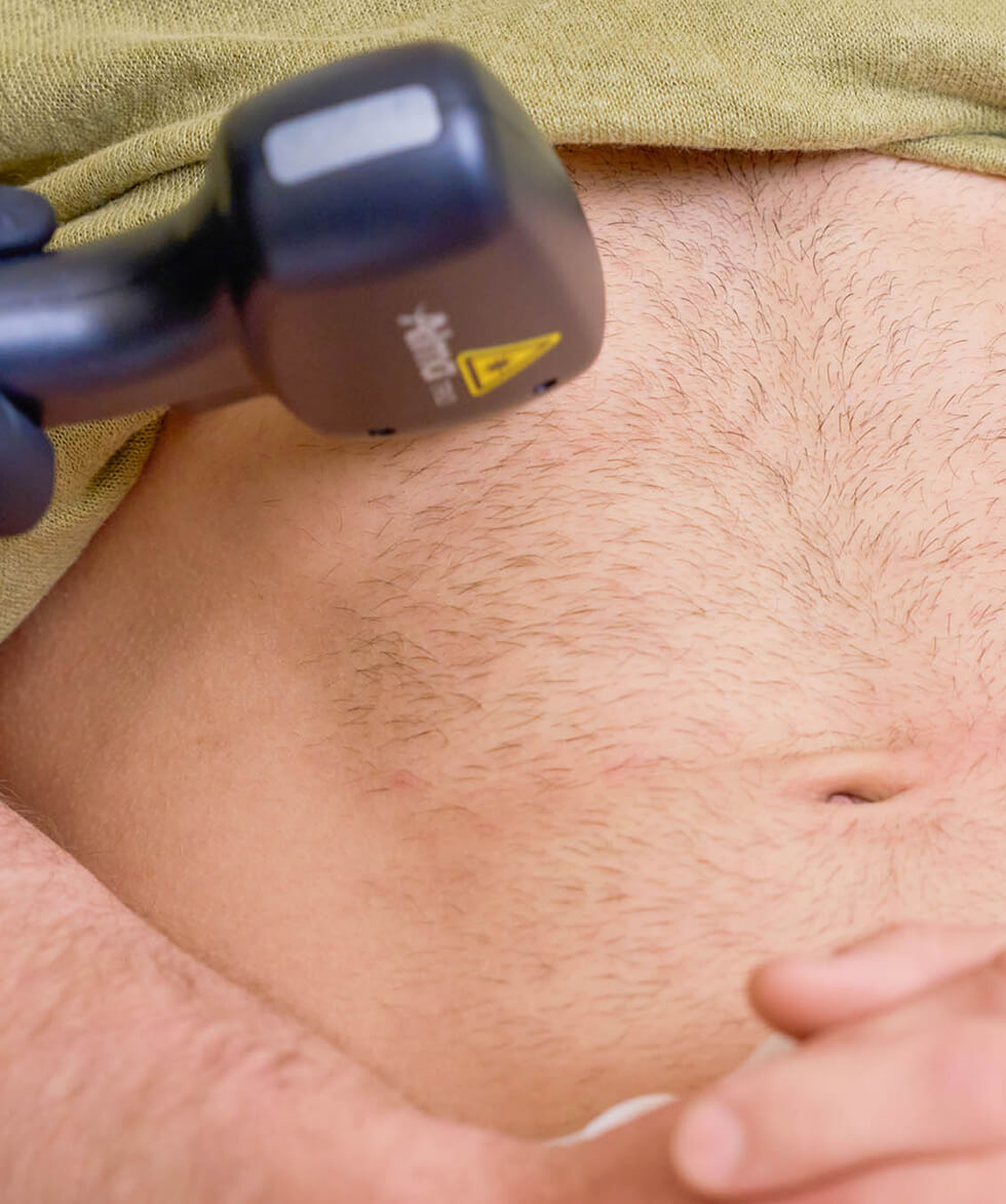 Laser Hair Removal in Vancouver, Burnaby, North Vancouver, and Port Coquitlam | EY