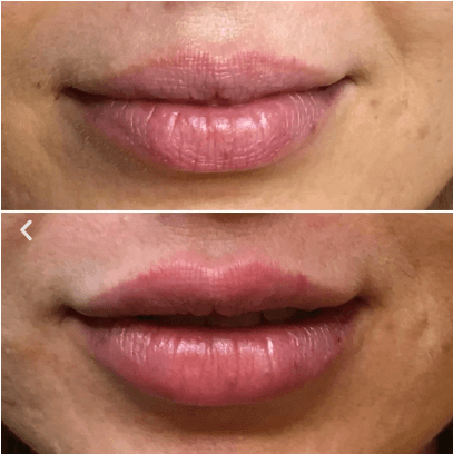 Lip Fillers Injections - Before & After 4 | EverYoung Skin Clinic Vancouver