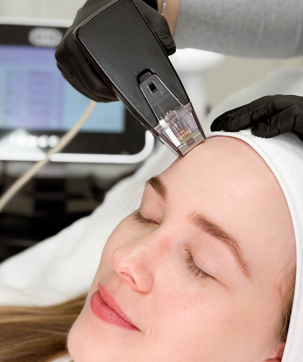 Morpheus8 in Vancouver, Burnaby, North Vancouver, and Port Coquitlam | EY