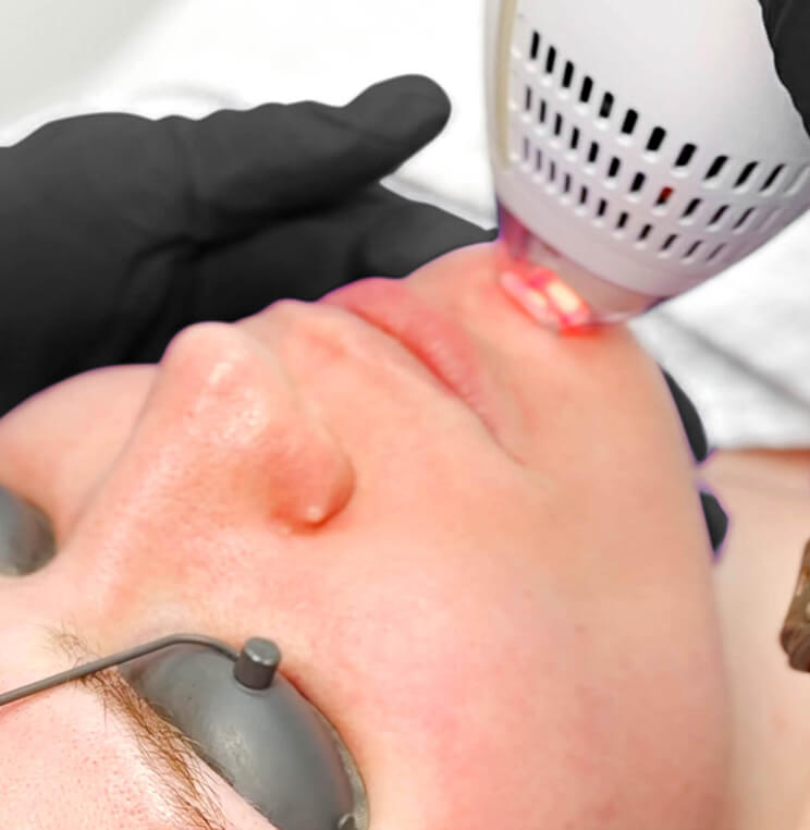 Vancouver Clear + Brilliant Treatment | EverYoung Skin Clinic