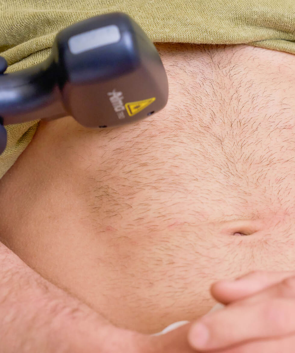 Laser Hair Removal Vancouver | EverYoung Laser Skin Clinic