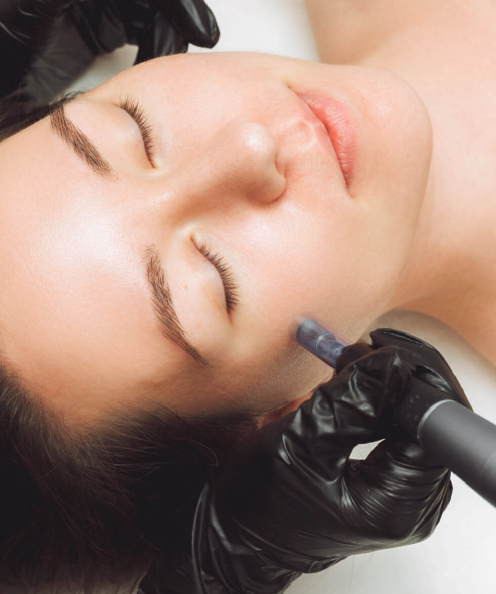Microneedling North Vancouver
