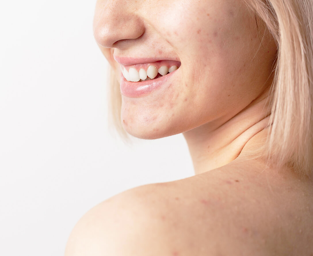 Cystic Acne Causes and Treatments | EverYoung Laser & Skin Clinics Vancouver