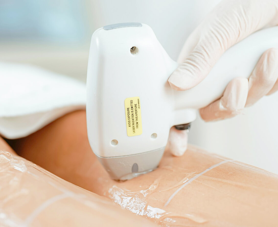 Does Laser Hair Removal Really Hurts? | EverYoung Laser Skin Clinic