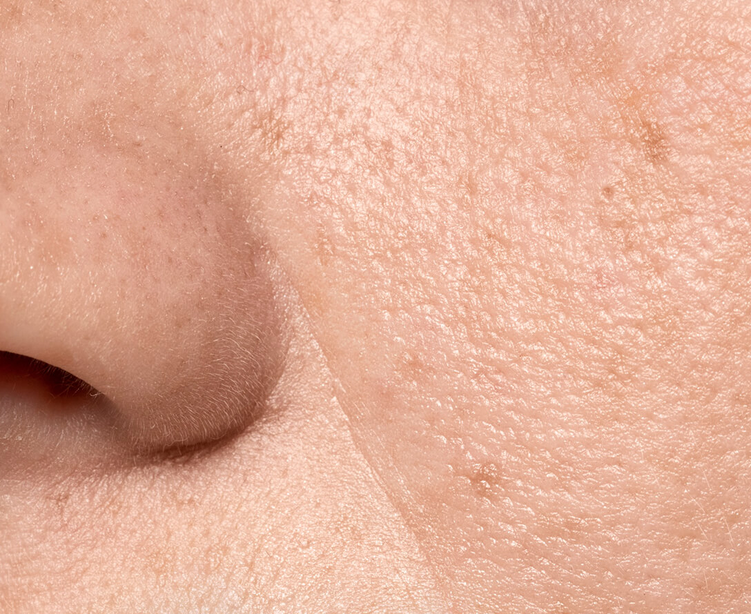 What is Dull Skin & How to Treat It? | EverYoung Skin Clinic