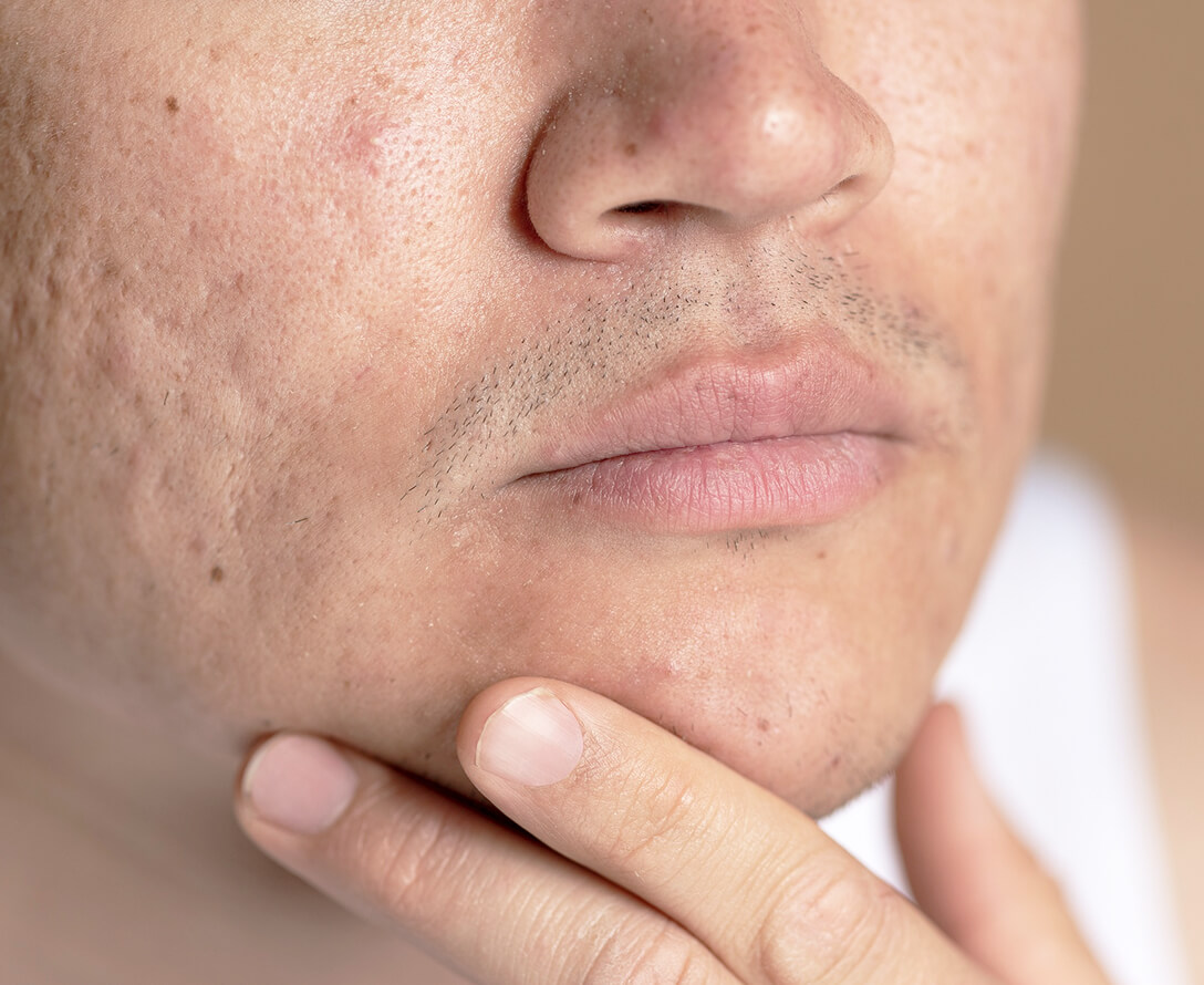 Fungal Acne Causes & Prevention Tips | EverYoung Laser & Skin Clinic