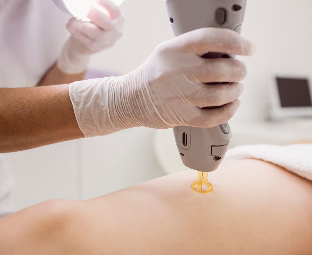 Laser Hair Removal Benefits & Side Effects | EverYoung Skin Clinic